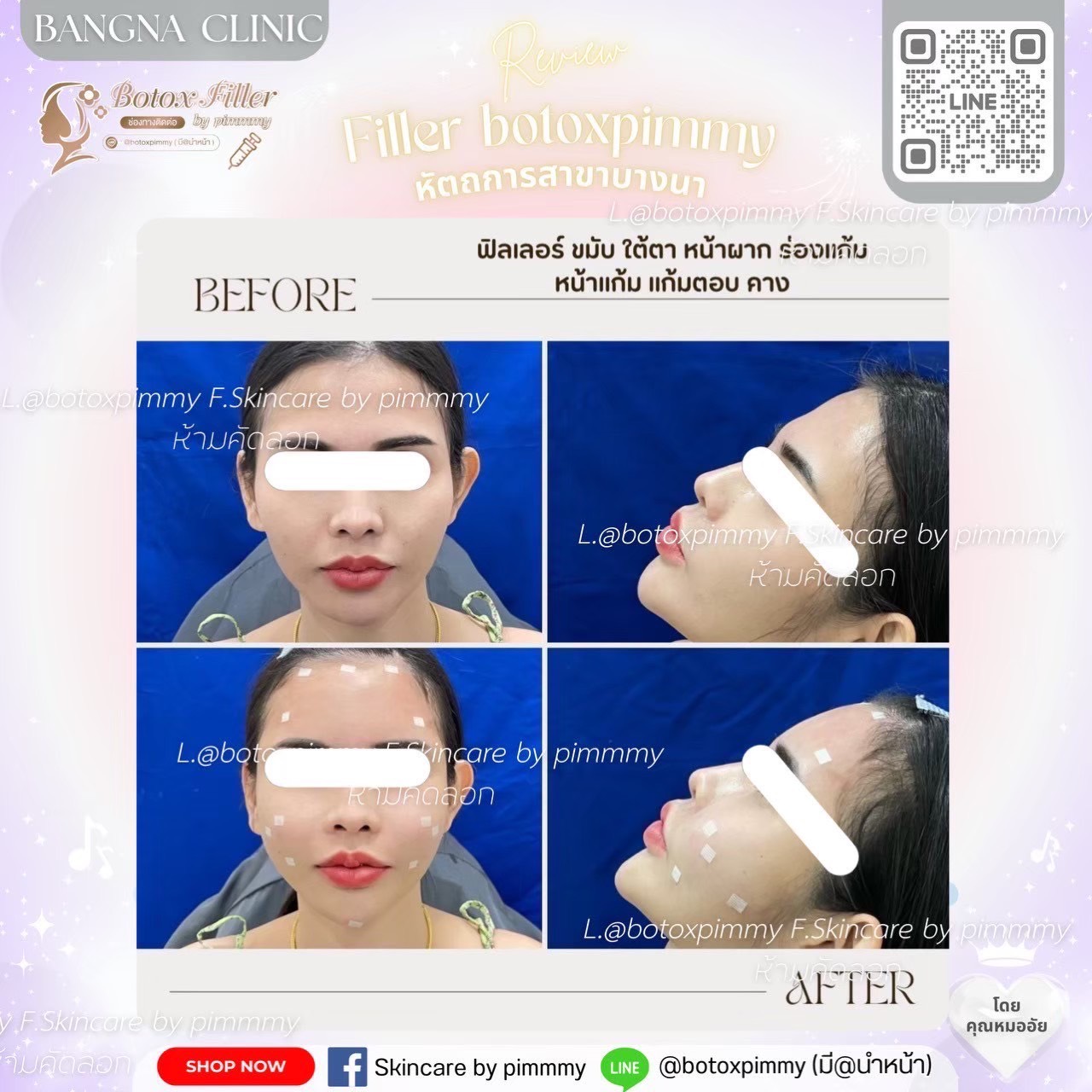 Before After ฟิลเลอร์และปรับรูปหน้า