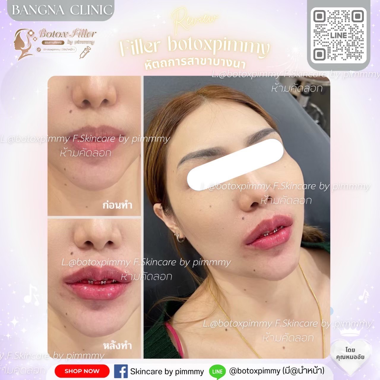 Before After ฟิลเลอร์และปรับรูปหน้า