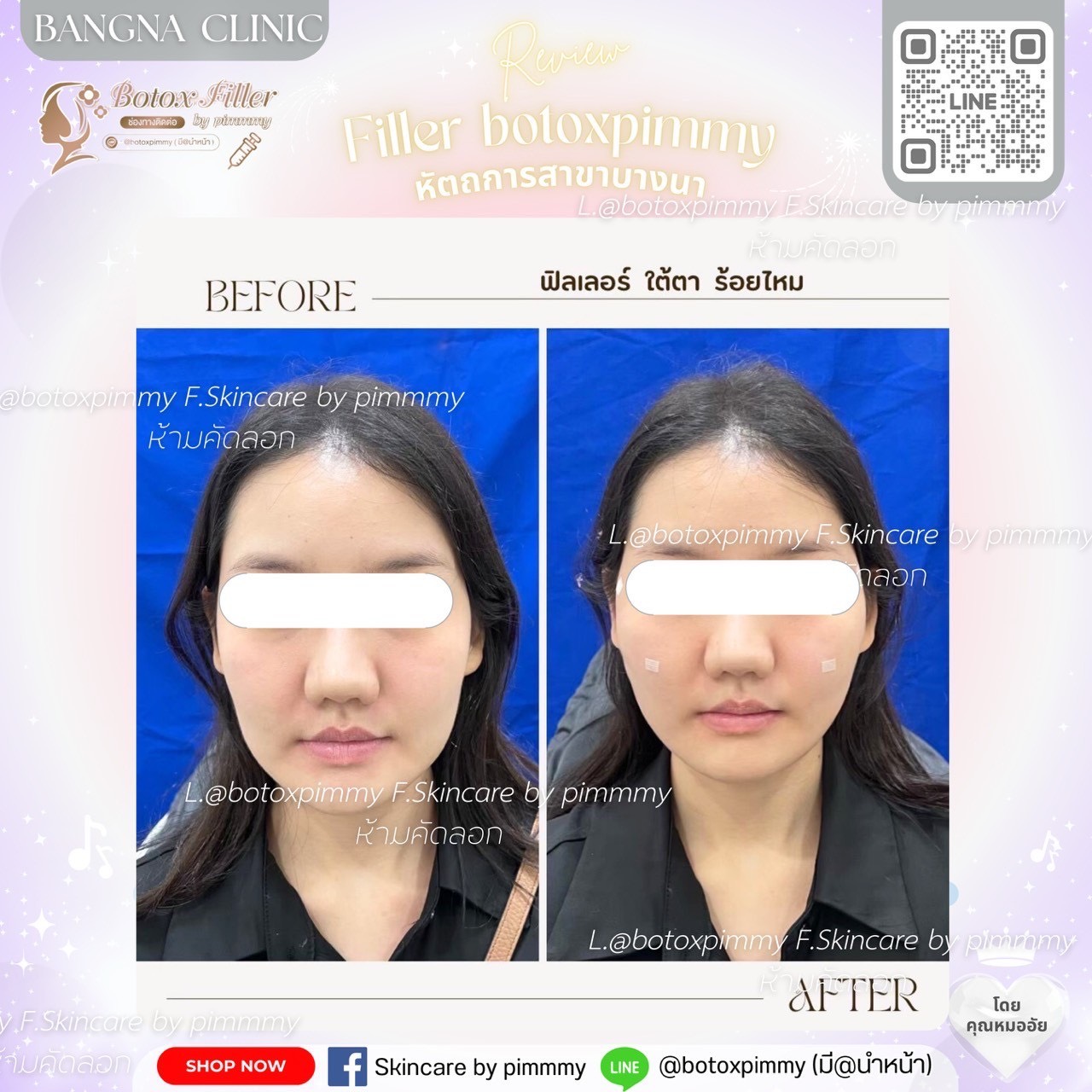 Before After ฟิลเลอร์และปรับรูปหน้า