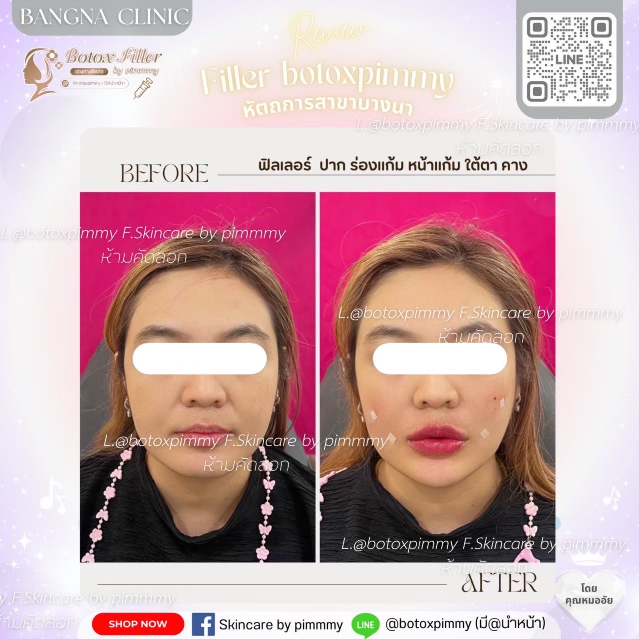 Before After ฟิลเลอร์และปรับรูปหน้า