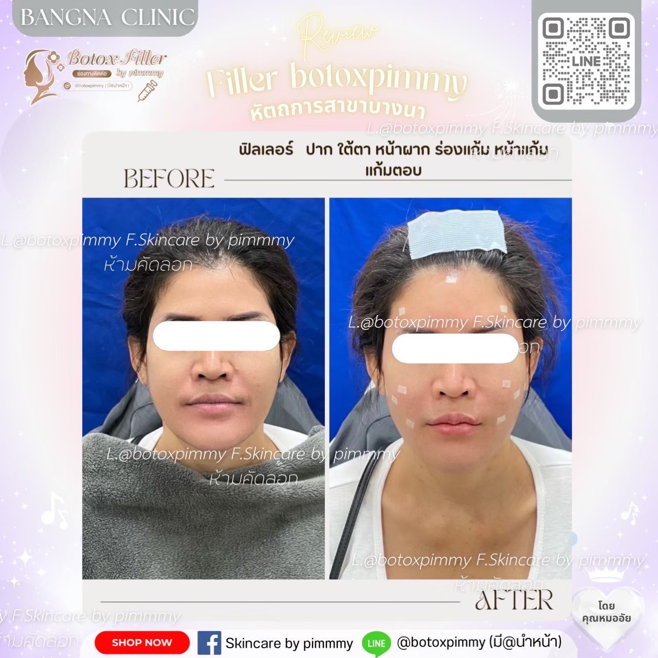 Before After ฟิลเลอร์และปรับรูปหน้า