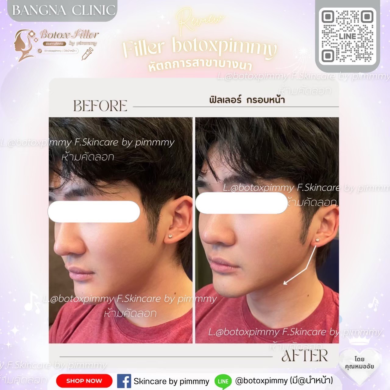 Before After ฟิลเลอร์และปรับรูปหน้า