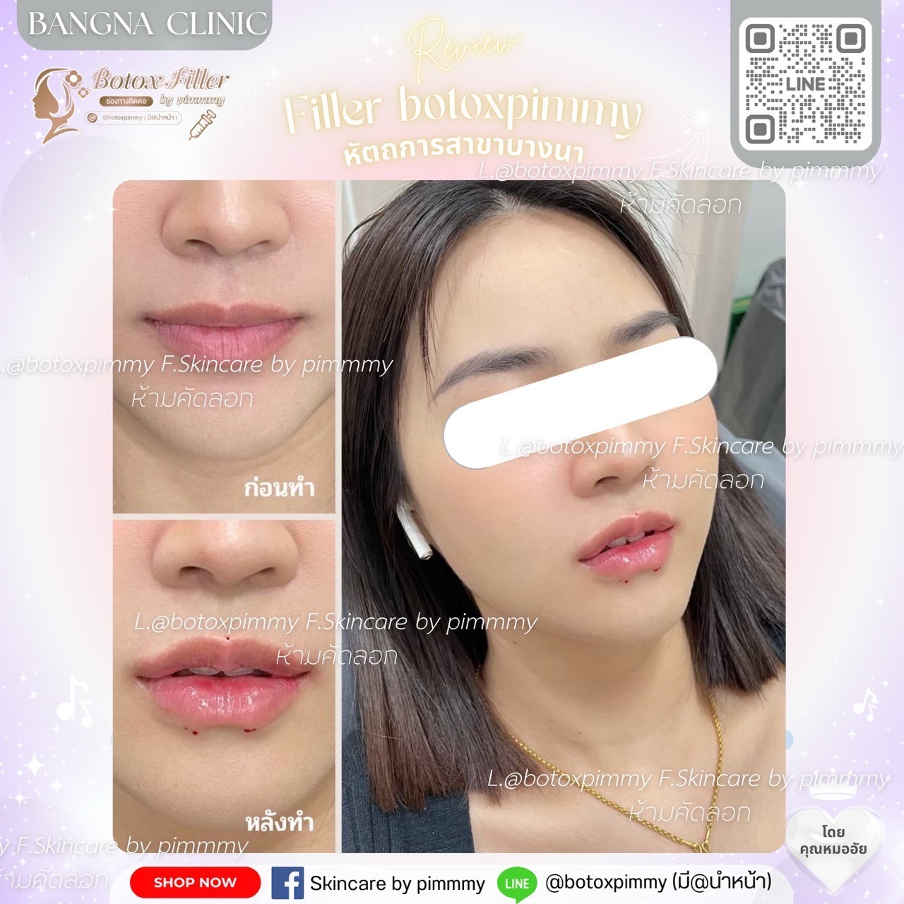 Before After ฟิลเลอร์และปรับรูปหน้า